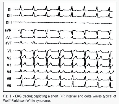 Wolff-Parkinson-White syndrome and the sinus venosus atrial septal defect association