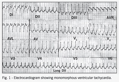Congenital ventricular diverticulum associated with ventricular tachycardia
