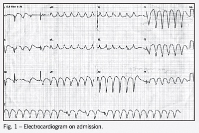 Positive troponin T in a chagasic patient with sustained ventricular tachycardia and no obstructive lesions on cine coronary angiography