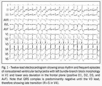 Ablation of idiopathic ventricular tachycardia with left bundle-branch block morphology located in the pulmonary trunk