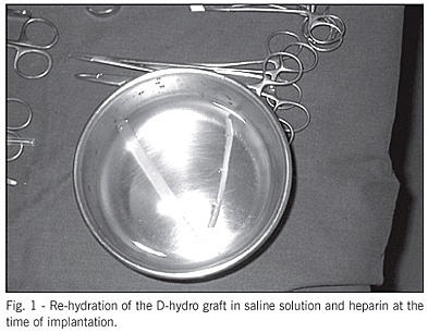 Initial analysis of the use of the L-D-Hydro (Eato L-D-Hydro) organic tubular graft for performing the modified Blalock-Taussig procedure in congenital heart diseases with decreased pulmonary blood flow