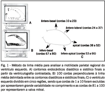 Avaliação quantitativa da movimentação parietal regional do ventrículo esquerdo na endomiocardiofibrose
