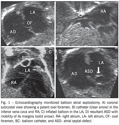 Echocardiographic monitoring of balloon atrial septostomy