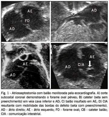 Monitoração ecocardiográfica da atriosseptostomia com balão