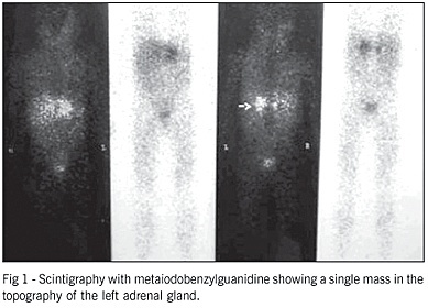 Pheochromocytoma in childhood