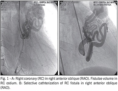 Large coronary-pulmonary artery fistulae: percutaneous embolization with microcoils and disposable balloons