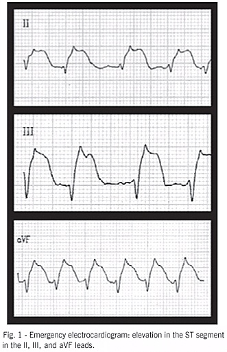 Multiple simultaneous embolisms of right and left coronary arteries