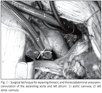 Correction of thoracic and thoracoabdominal aortic aneurysms: central cannulation technique