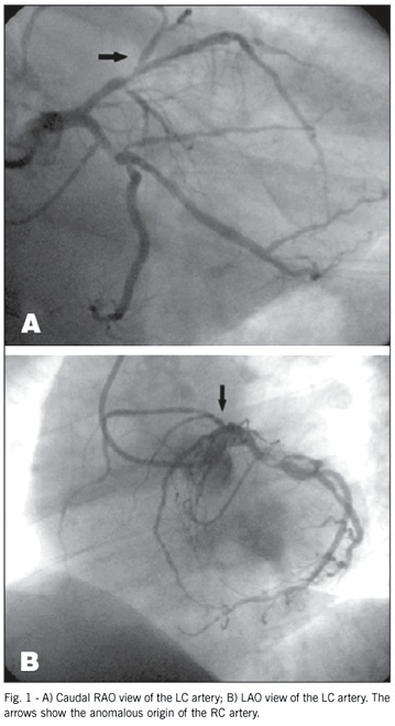 Percutaneous transluminal coronary angioplasty in a patient with idiopathic thrombocytopenic purpura