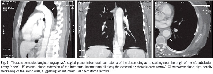 Intramural haematoma of the descending aorta
