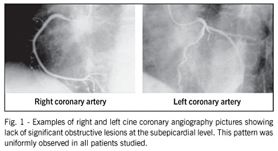 Post-extrasystolic potentiation in chronic Chagas' heart disease: a radiologic contrast ventriculography study