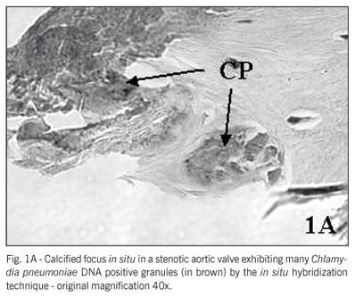 Chlamydia pneumoniae and Mycoplasma pneumoniae in calcified nodes of stenosed aortic valves