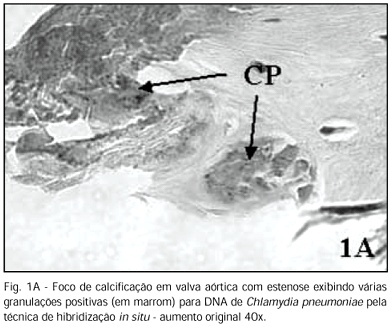 Chlamydia pneumoniae e Mycoplasma pneumoniae nos nódulos de calcificação da estenose da valva aórtica