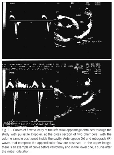 Functional assessment of the left atrial appendage at transesophageal echocardiography before and after percutaneous valvotomy in the mitral stenosis