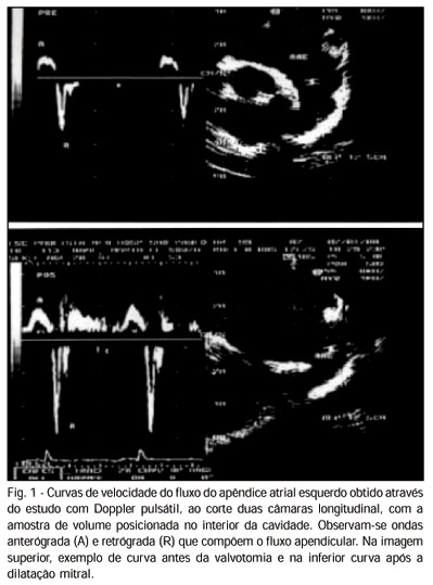 Avaliação funcional do apêndice atrial esquerdo ao ecocardiograma transesofágico antes e após valvotomia percutânea na estenose mitral