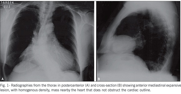 Dyspnea through compression of mediastinal structures due to pericardial cyst