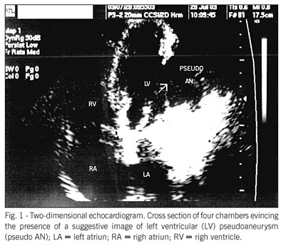 Left ventricular pseudoaneurysm associated to severe mitral insufficiency, complicating inferolaterodorsal acute myocardial infarction