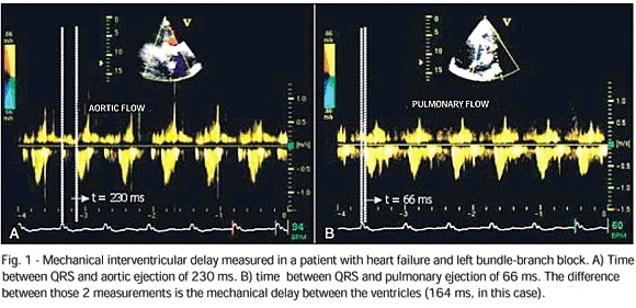 Echocardiographic assessment of cardiac resynchronization therapy