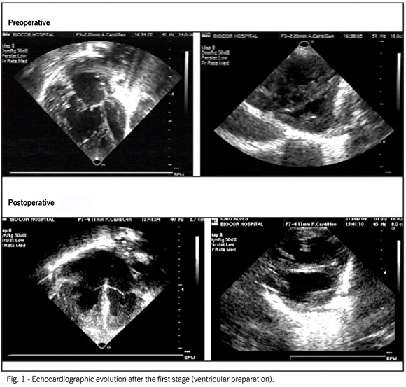 Surgical strategy for transposition of the great arteries with intact ventricular septum after the neonatal period