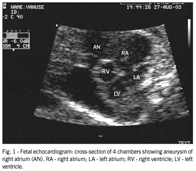 Right atrial aneurysm associated to fetal hydrops: diagnosis through fetal echocardiography