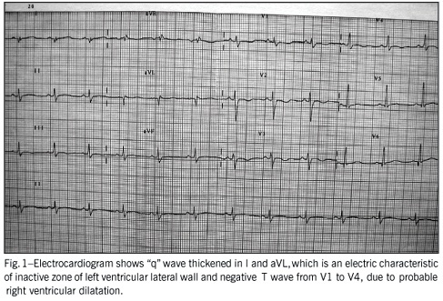 Prevailing right ventricular myocardiopathy for previous myocarditis or arrhythmogenic dysplasia?