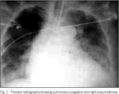 Takotsubo cardiomiopathy: a rare cause of cardiogenic shock simulating acute myocardial infarction
