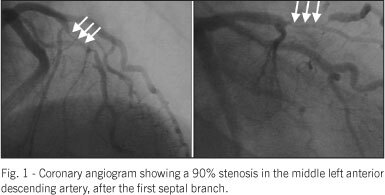 Diffuse atherosclerotic disease unmasked by invasive physiologic assessment of coronary flow