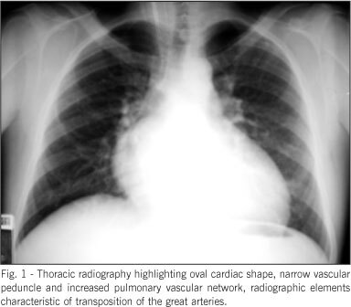 Forty days old infant with transposition of the great arteries and ventricular septal defect