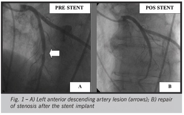 State of the art percutaneous procedure: octogenarian patient successfully submitted, in a single session, to a pulmonary valvotomy, coronary stent implant and permanent pacemaker implant