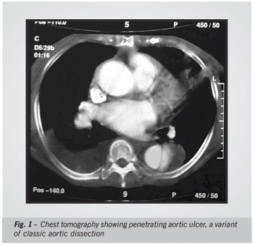 Percutaneous management of penetrating aortic ulcer