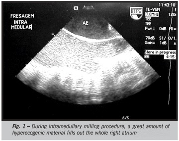Fat pulmonary embolism during orthopedic surgery monitored through transesophageal echocardiogram