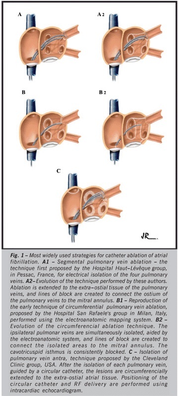 Catheter ablation of atrial fibrillation: techniques and results