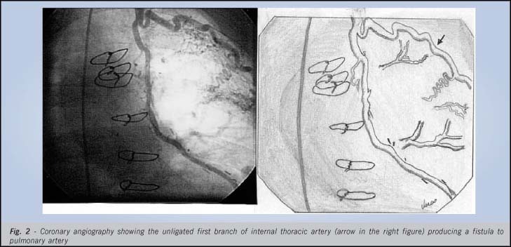 Left internal thoracic artery to left pulmonary artery fistula after coronary artery bypass graft surgery: a rare cause of myocardial ischemia
