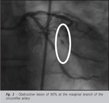 Coronary artery aneurysm one year and five months after sirolimus-eluting stent placement
