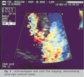 Aorta-right ventricle fistula: an unexpected complication of bacterial endocarditis