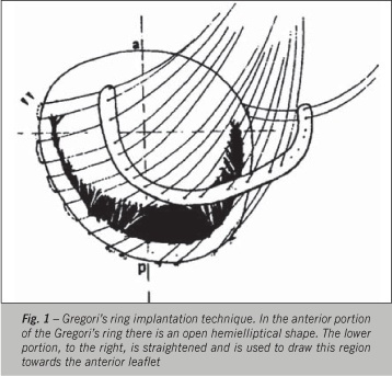 Late heart evaluation of children with rheumatic mitral regurgitation submitted to reconstructive surgery with implantation of Gregori's ring