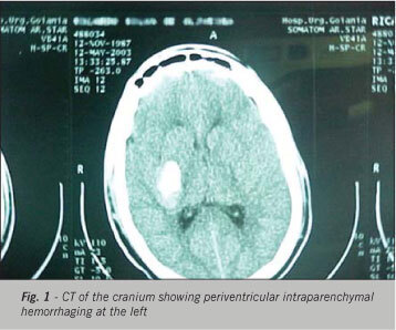 Congenital adrenal hyperplasia due to 11-beta-hydroxylase deficiency