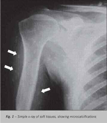 Restrictive cardiomyopathy due to myocardial cysticercosis