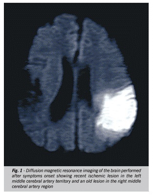 Intra-arterial autologous bone marrow mononuclear cell transplantation for acute ischemic stroke
