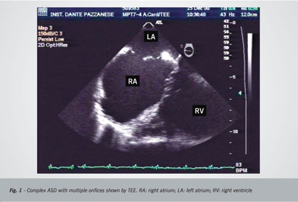 The role of echocardiography in the percutaneous treatment of septal defects