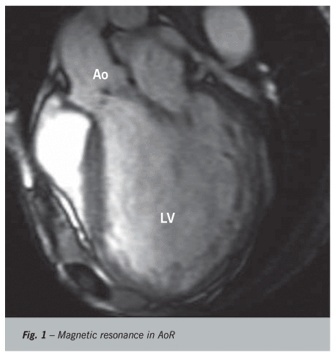 Symptomatic severe chronic aortic valve disease: a comparative study of cardiac magnetic resonance imaging and echocardiography
