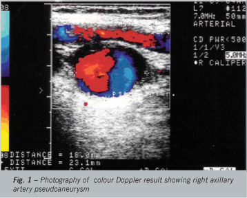 Atrogenic pseudoaneurysm of axillary artery