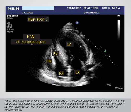Real time tridimensional echocardiography in a patient with hypertrophic cardiomyopathy