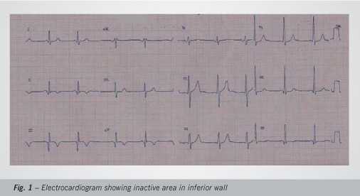 Spontaneous coronary artery dissection causing acute coronary syndrome