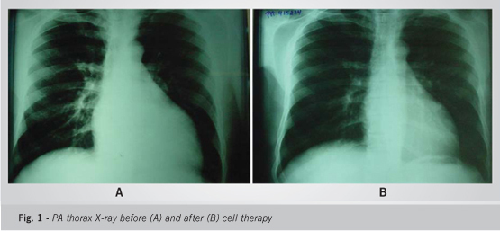 Cell therapy in dilated cardiomyopathy