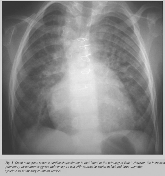 Case 1/2006 - eight-month-old infant with pulmonary atresia and ventricular septal defect and increased pulmonary blood flow