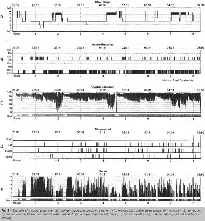 Cardiovascular comorbidities and obstructive sleep apnea
