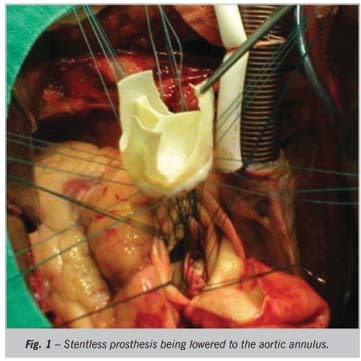 Surgical treatment of aortic valve disease with stentless bovine pericardium prosthesis: immediate results