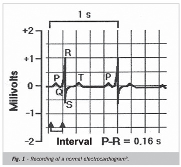 Analysis of electrocardiographic recordings associated with acute myocardial infarction