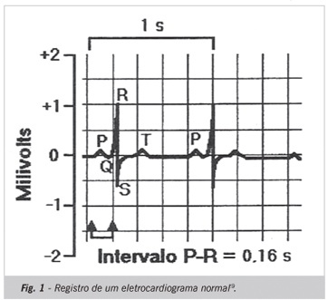 Análise de registros eletrocardiográficos associados ao infarto agudo do miocárdio